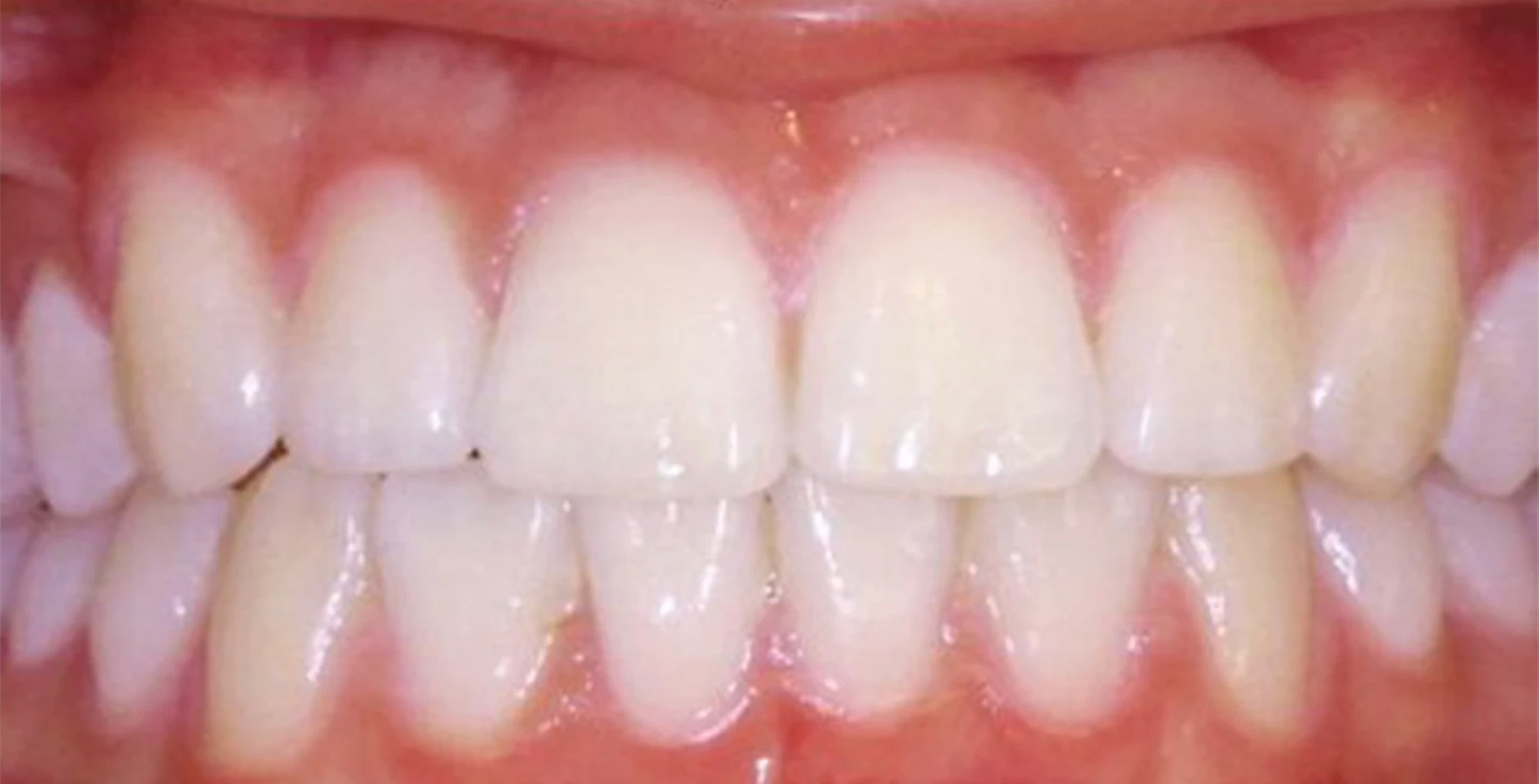 Routine Dentistry after smile
