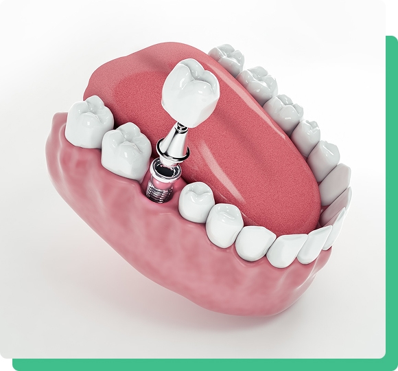 Finally Smile With Confidence And Eat The Things You've Always Wanted